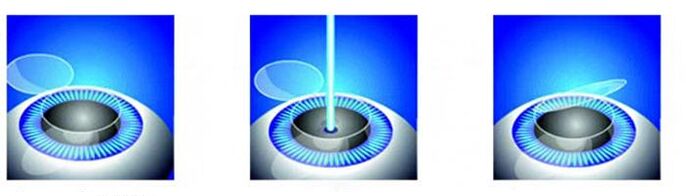 Laser vision correction phase