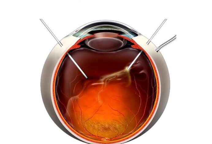 Vitrectomy - Operation for restoring vision